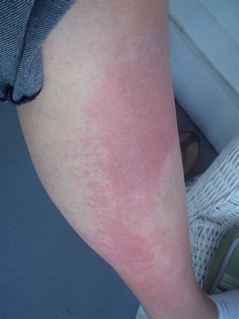 I Developed A Rash On My Legs That Was Itchy A Few Hours After