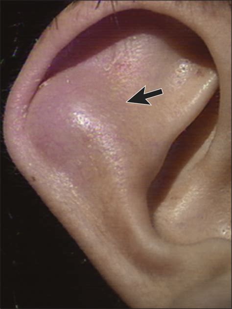 Ent Tumors Of External Ear