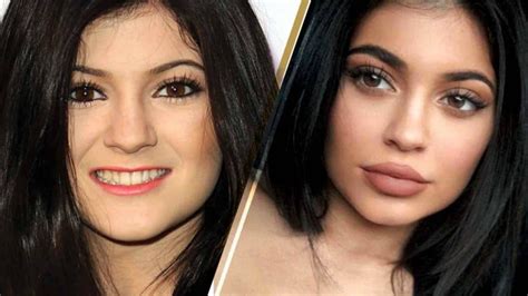 Kylie Jenner Before And After Plastic Surgery Photos