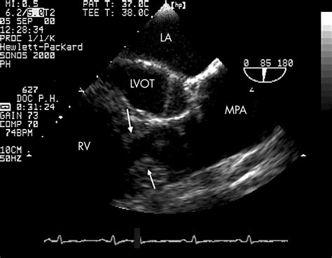 The Role Of Echocardiography In Diagnosing Double Chambered Right