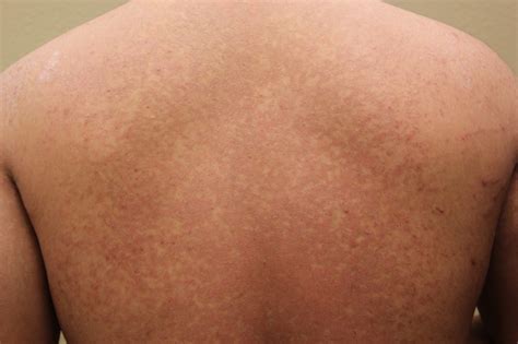 Tinea Versicolor Before And After