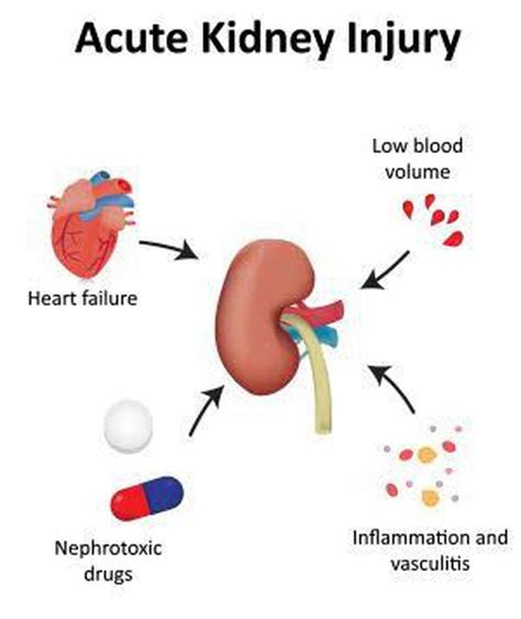 Acute Kidney Injury Medizzy