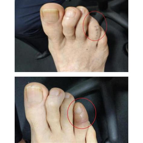 Hammer Toe In With Pin