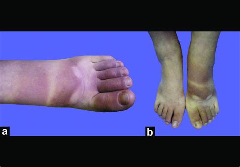 Well Demarcated Dark Brown Patches On The Dorsum Of Left Foot And