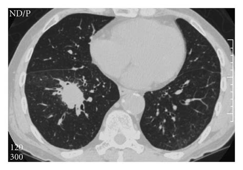 Computed Tomography Of The Thorax Showed A Soft Tissue Density Nodule