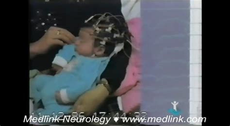 benign sleep myoclonus of infancy medlink neurology