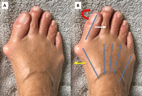 Hallux Valgus Bunion Conditions The London Foot And Ankle Clinic
