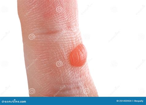 On Finger There Is Redness Blister Stock Photo Image Of Cosmetology