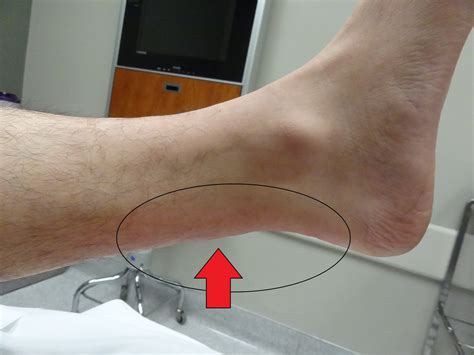 This tendon helps your leg bend when you raise your knee. Run Lily Run: Ruptured Achilles Tendon - The Beginning.