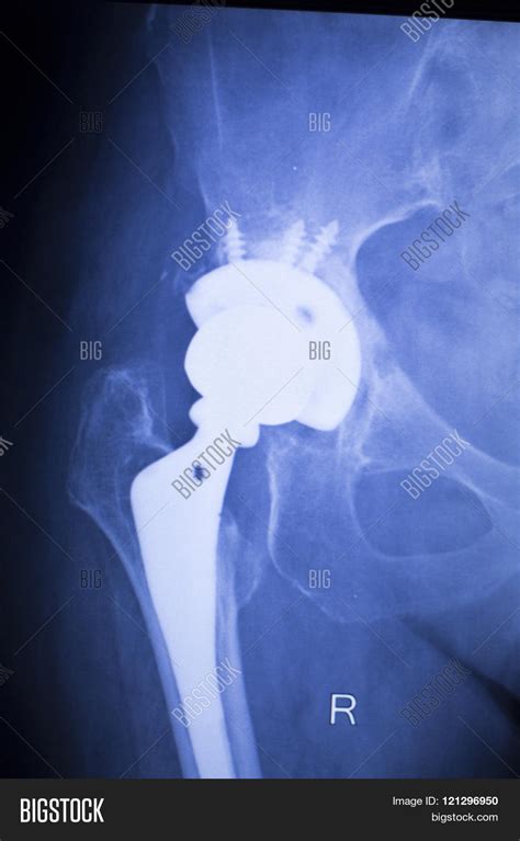 Hip Replacement Xray Image And Photo Free Trial Bigstock
