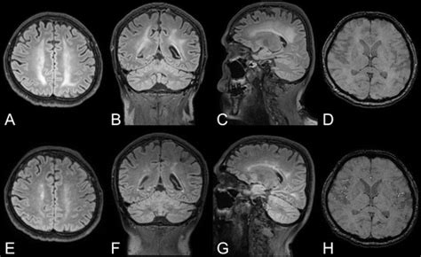 Nervous System Involvement In Coronavirus Disease 2019 Results From A