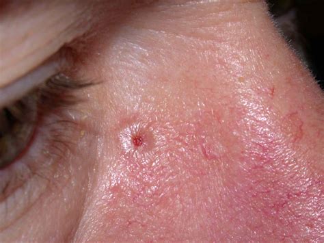 White Bumps On Face Milia And 7 Other Causes