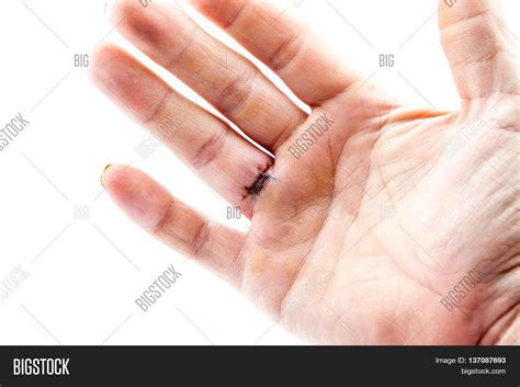 After Removal Cyst Finger Hand This Image And Photo Bigstock