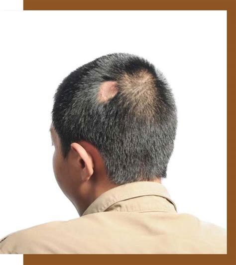 Scarring Alopecia Causes Types Symptoms And Treatments Dermiq Clinic
