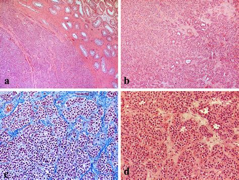 Leydig Cell Tumors Of The Testis A The Tumor Was Surrounded By An