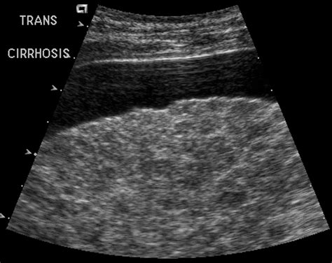 Sonography Of Diffuse Liver Disease