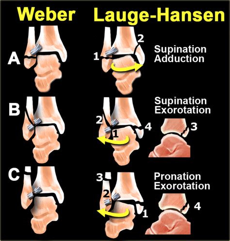 Ankle Fracture Weber And Lauge Hansen Classification Ankle Fracture Radiology Imaging