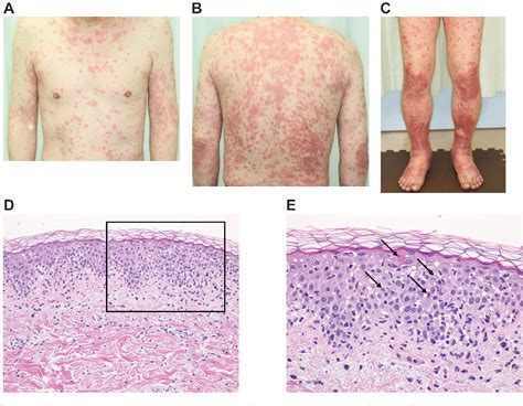 Figure 1 From Severe Skin Disorders Due To Sorafenib Use After
