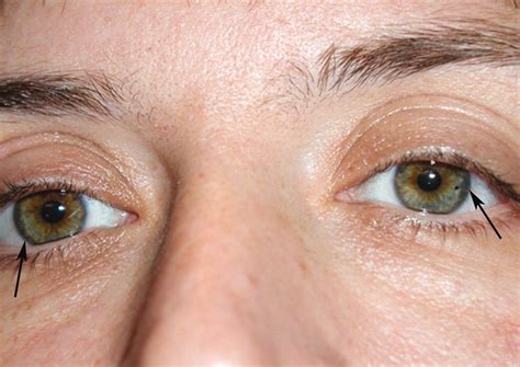 Wilson's Disease: Stages, Causes and Symptoms