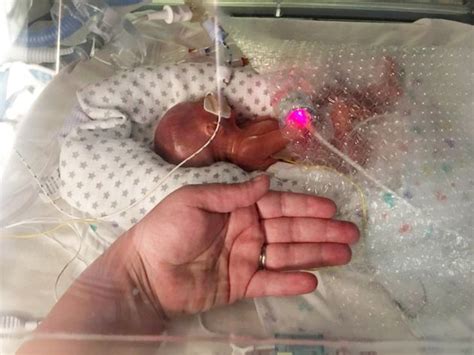 One Of Britains Most Premature Babies Defies Odds After Being Born