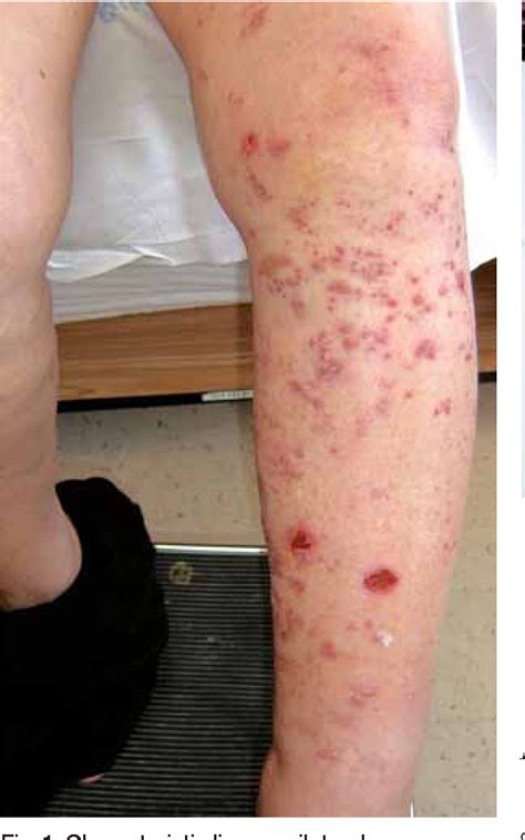 Figure 2 From Herpes Zoster Following Intra Articular Corticosteroid