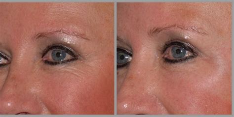 Botox Around Eyes Benefits Before And After Results Cost Side