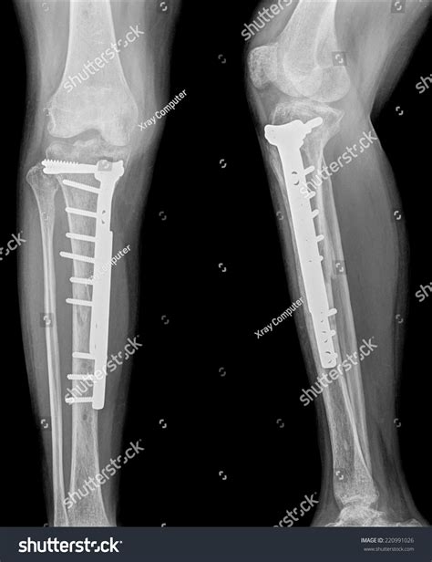Film Leg Aplateral Show Fracture Shaft Stock Photo 220991026 Shutterstock