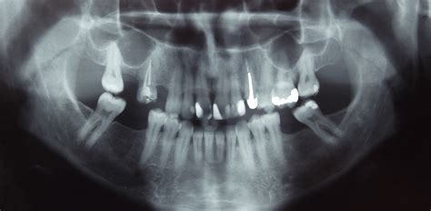 Dental Radiographs Skygate Dental