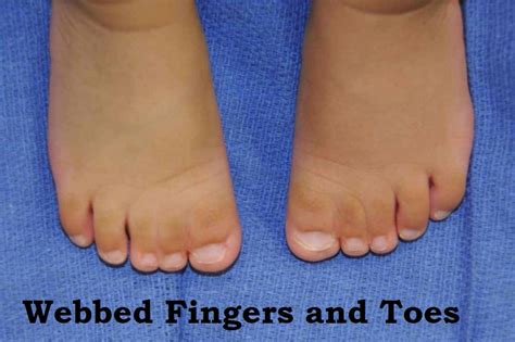 How To Care For Webbed Fingers And Toes Generalskup