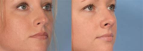 Rhinoplasty Nose Reshaping Before And After Pictures Case 87 Naples
