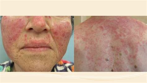 Skin Manifestation Of Systemic Disease