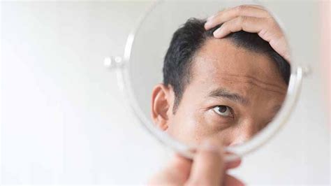 Male Pattern Baldness Causes Symptoms And Prevention The Wellness