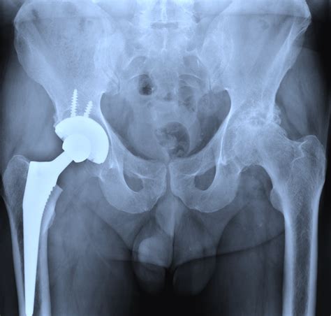 2 Million Verdict In Zimmer Kinectiv Hip Implant Lawsuit Daily