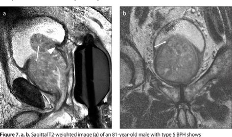 Figure 7 From Magnetic Resonance Imaging Of Benign Prostatic
