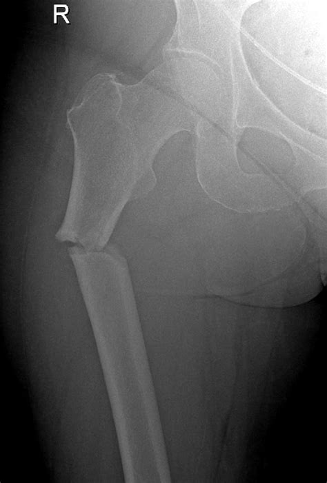 Radiographs Of Left Femur Showing Pathological Fracture Right Humerus
