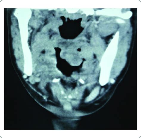 1 Ct Scan Neck Coronal View Showing Irregular Mass Attached To The