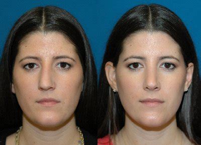 Learn how to contour your nose. Rhinoplasty for Hooked Nose | Rhinoplasty for Crooked Nose