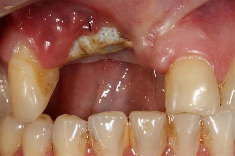 Pain 4 Weeks After Dental Bone Graft Causes Symptoms And Treatment