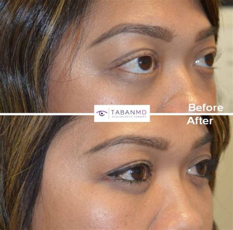 Visit our website to book an appointment online: How To Get Cat Eyes Surgery