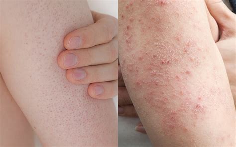 Understanding Keratosis Pilaris A Guide To Accurately Identifying This