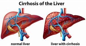 Detailed Guide on Liver Cirrhosis - Narayana Health Cirrhosis  