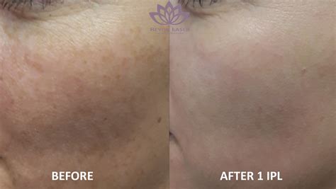 Ipl Before And After 3 Revive Laser And Skin Clinic