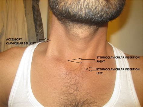 figure 1 from accessory clavicular sternocleidomastoid causing torticollis in an adult