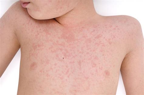 German Measles Rubella Causes Symptoms Treatments And Home Remedies