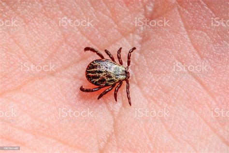 Infectious Encephalitis Tick Insect On Skin Encephalitis Virus Or Lyme