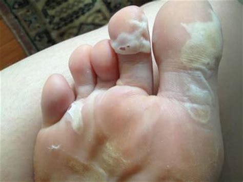 Skin peeling at the bottom of toes is an early warning sign. How to Cure Peeling Skin on Feet | IYTmed.com