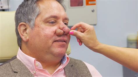Rhinophyma Causes Risk Factors Symptoms And Treatment