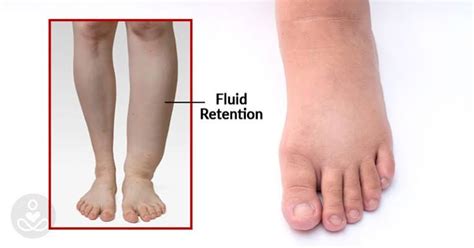 Edema Symptoms Treatment Causes And Types