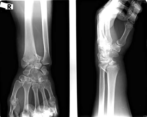 Right Wrist Radiographs Showing A Displaced Intra