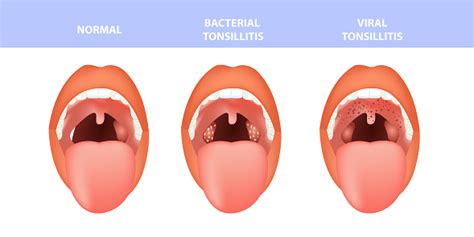 Open Mouth Normal And Tonsillitis Bacterial And Viral Angina